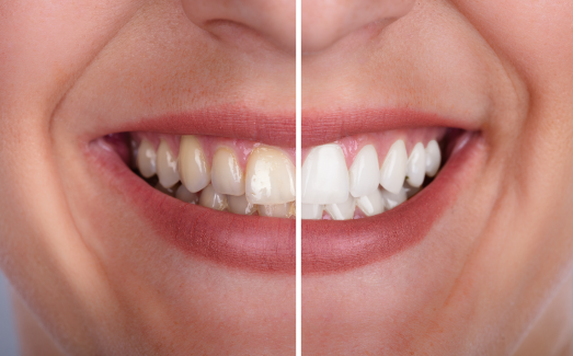 Clareamento Dental
